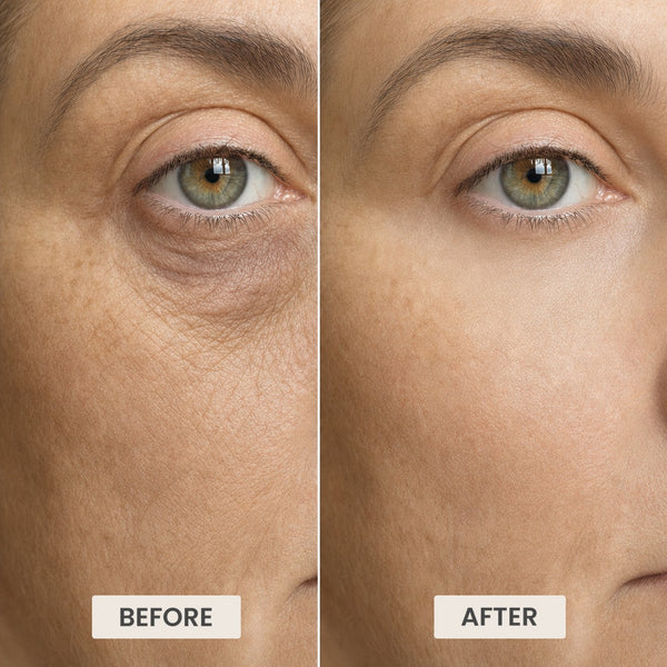 Crepey under-eye skin before, smooth under-eye skin after (illustrative image)